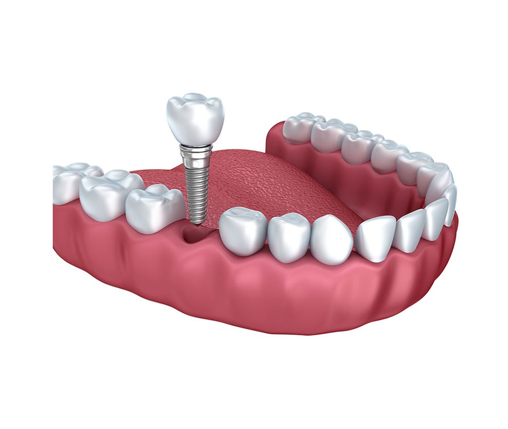 Cấy ghép Implant Thay Thế 1 Răng - Nha Khoa Anna