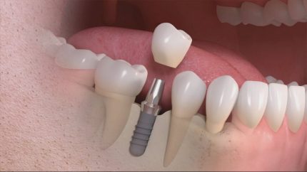 Có nên trồng răng implant