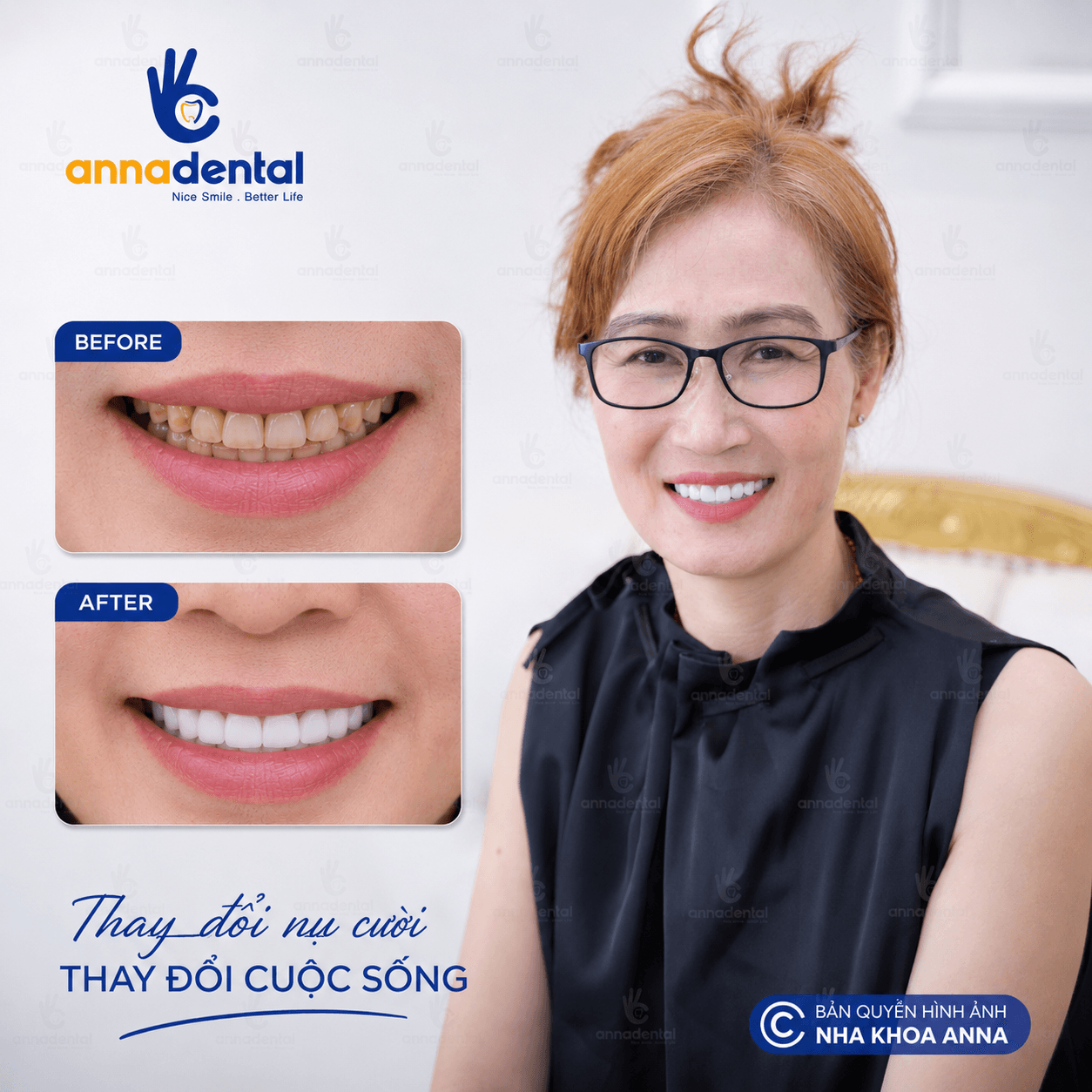 Chị Hậu Hoàn Thành Bọc Răng Sứ Tại Nha Khoa Anna