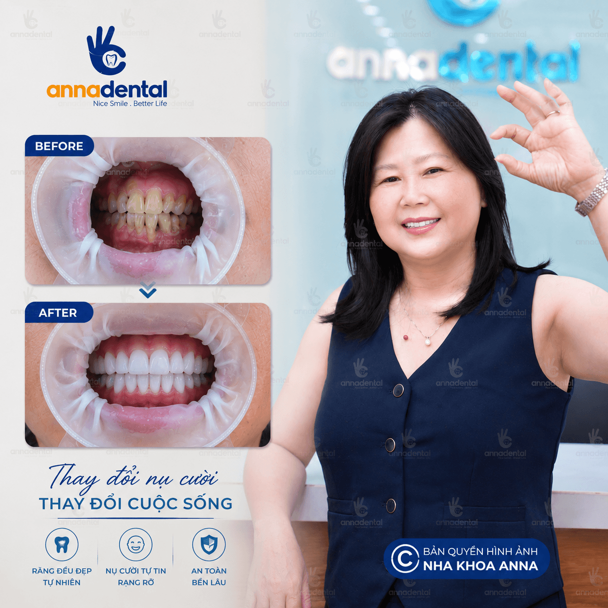 Cô Hồng Liên Chia Sẽ Cảm Nhận Khi Bọc Răng Sứ Tại Anna