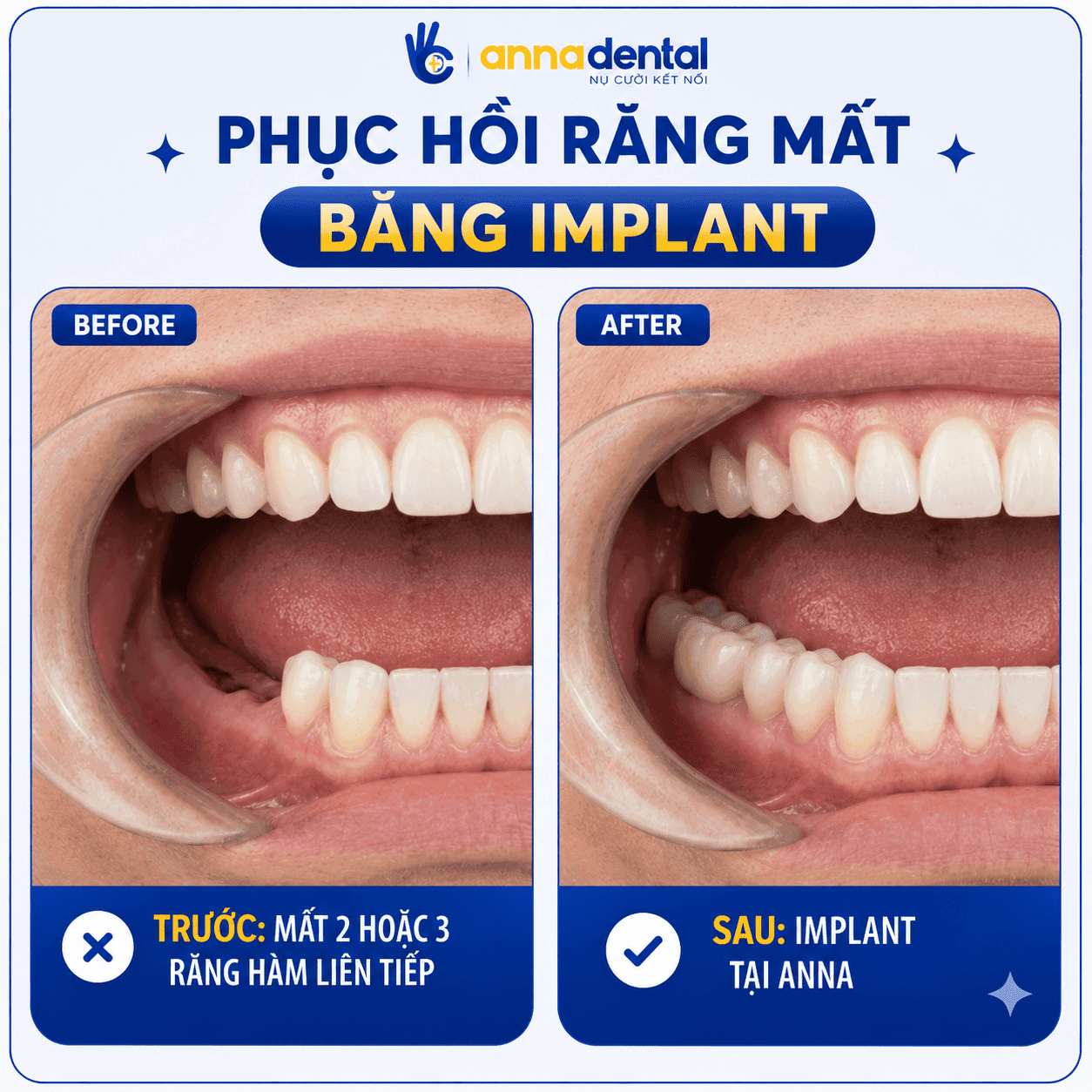 Mất 2 hoặc 3 răng hàm liên tiếp