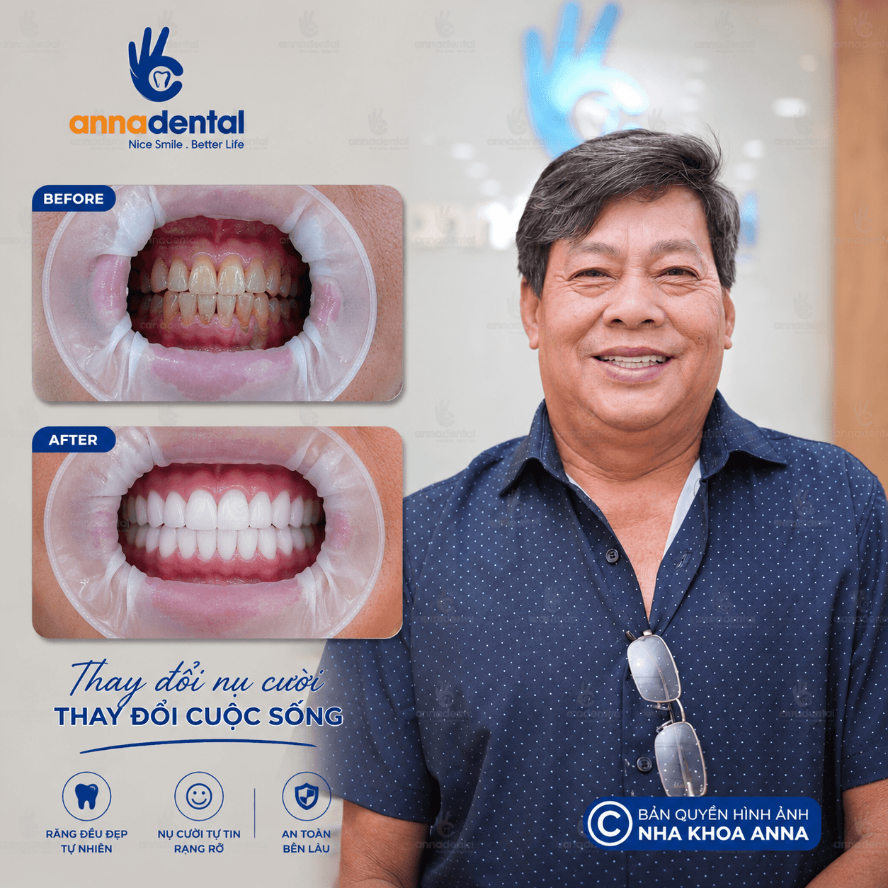 Chú Văn Minh Chia Sẽ Quá Trình Bọc Sứ Tại Anna