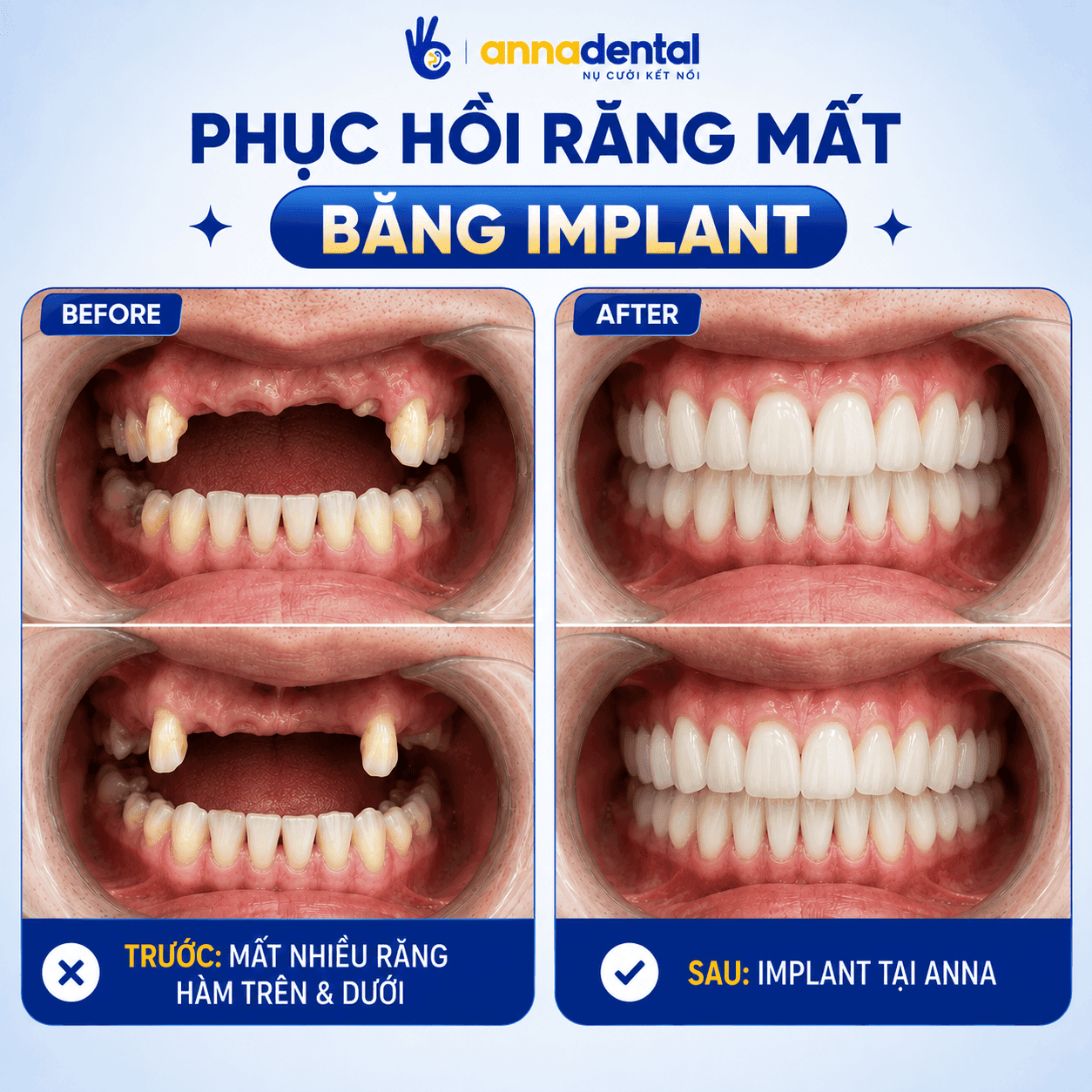 Mất nhiều răng hàm trên hoặc răng hàm dưới