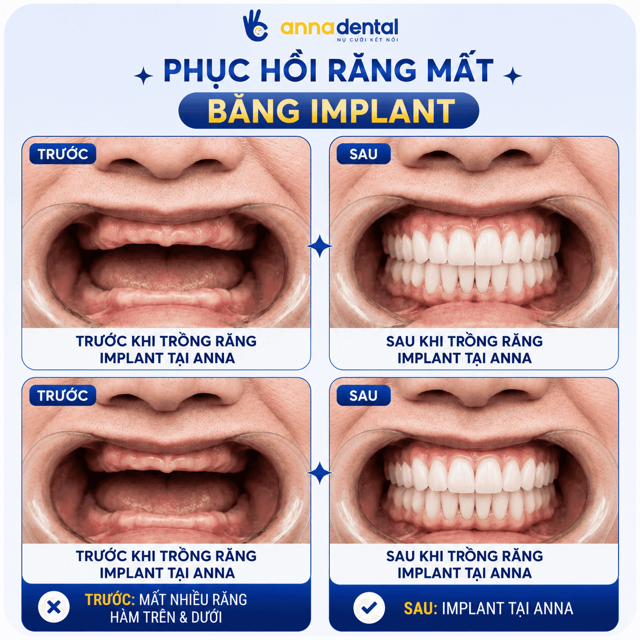 Mất toàn bộ răng cả hàm trên và hàm dưới