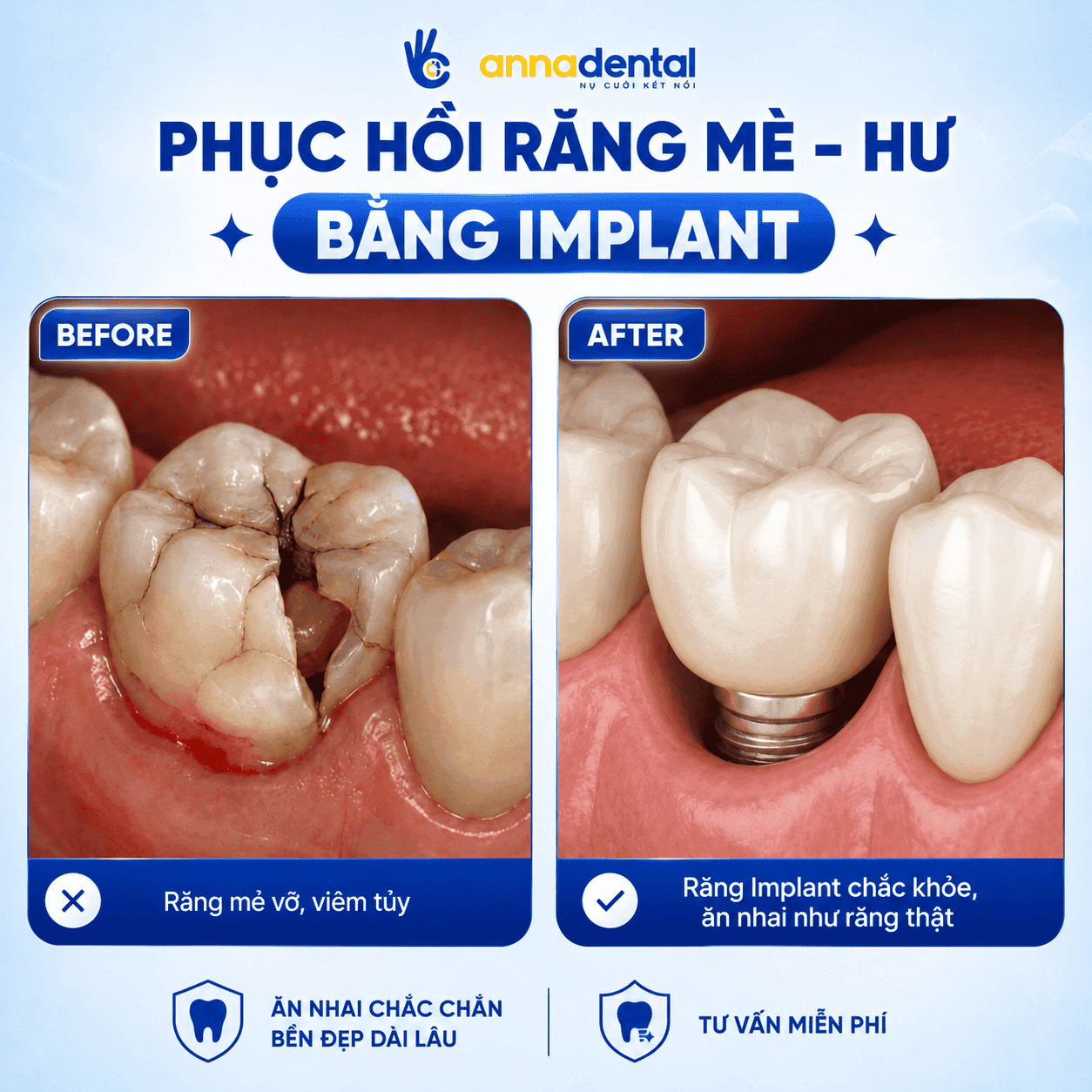 Răng sứt mẻ, gãy vỡ, viêm tủy,