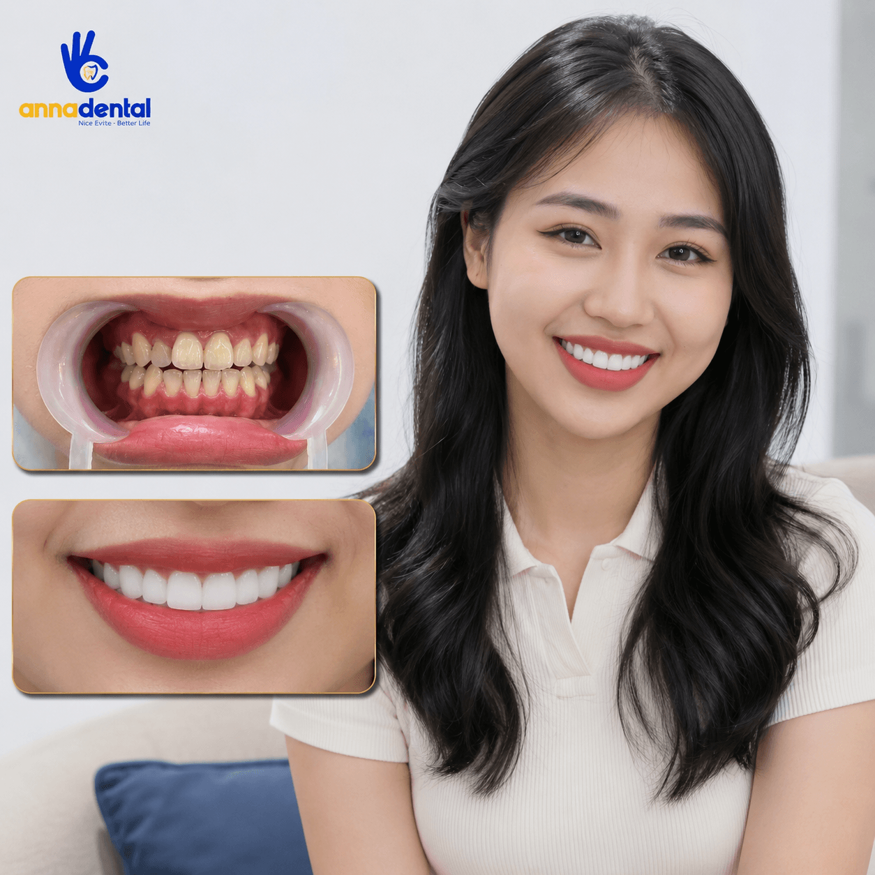 Chị Thu Trang Bọc Sứ Tại Anna