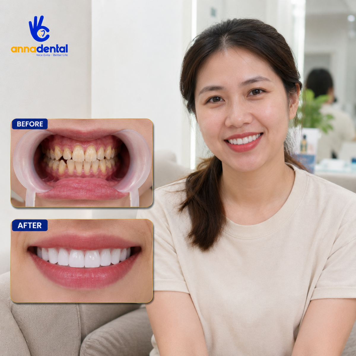 Chị Nguyễn Thị Thảo Bọc Sứ Tại Anna