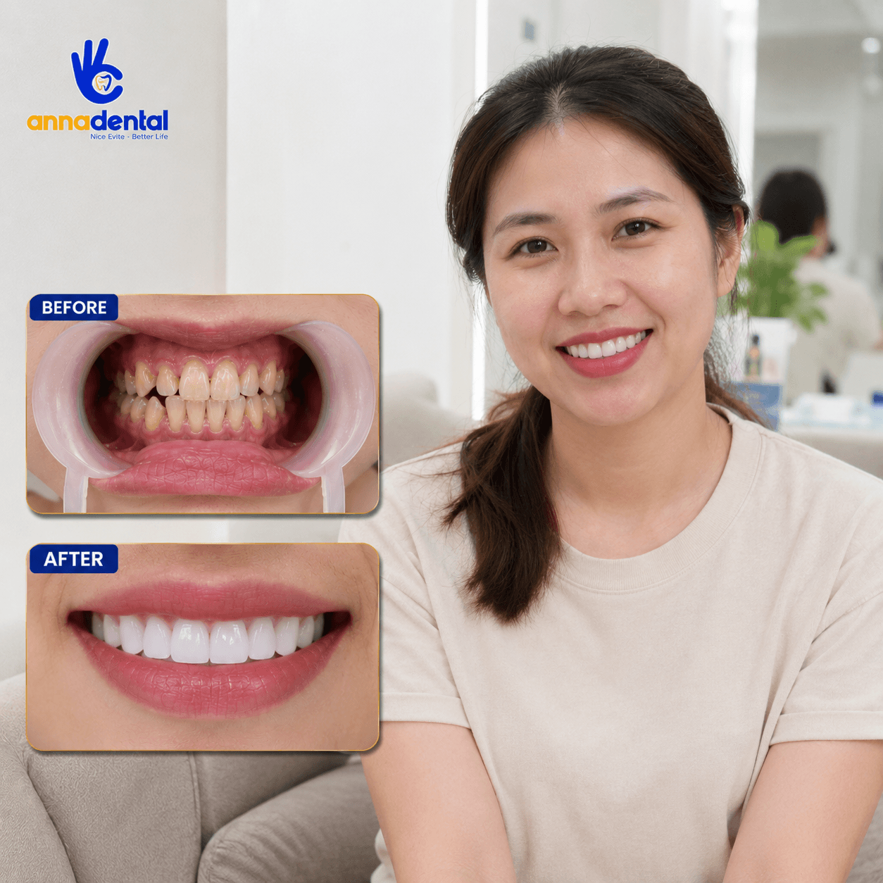 Chị Nguyễn Thị Thảo Bọc Sứ Tại Anna