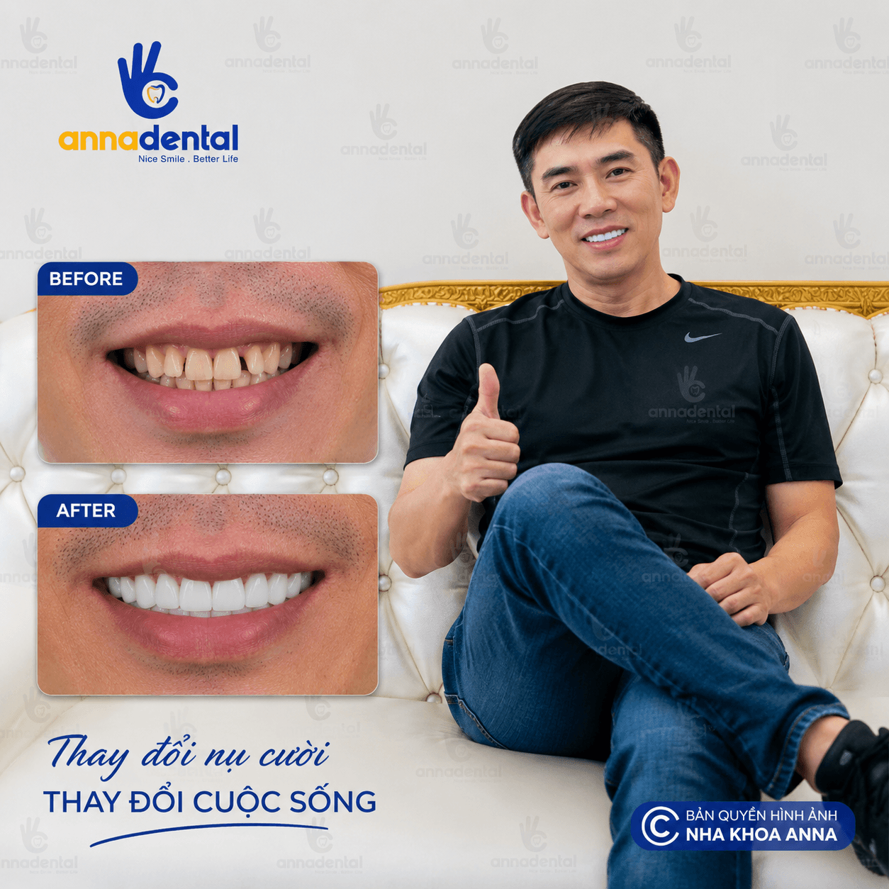 Anh Cường Bọc Răng Sứ Tại Anna Cảm Nhận Sau Điều Trị