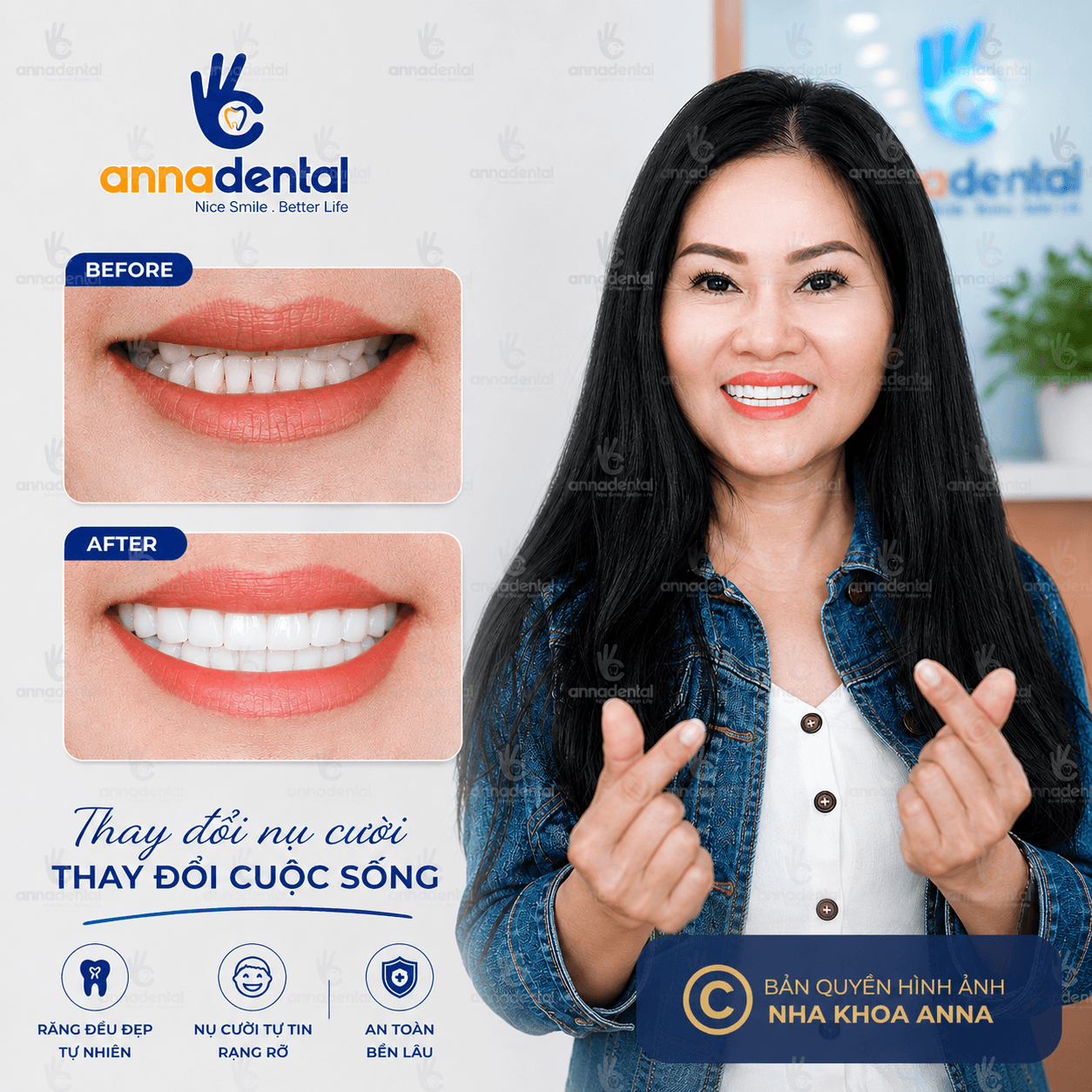 Cô Mai Trâm – Bọc răng sứ thẩm mỹ tại Anna