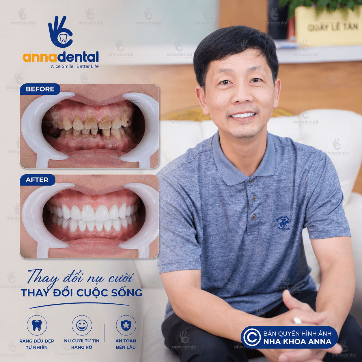 Anh Huỳnh Vinh Chia Sẽ Bọc Răng Sứ Tại Anna
