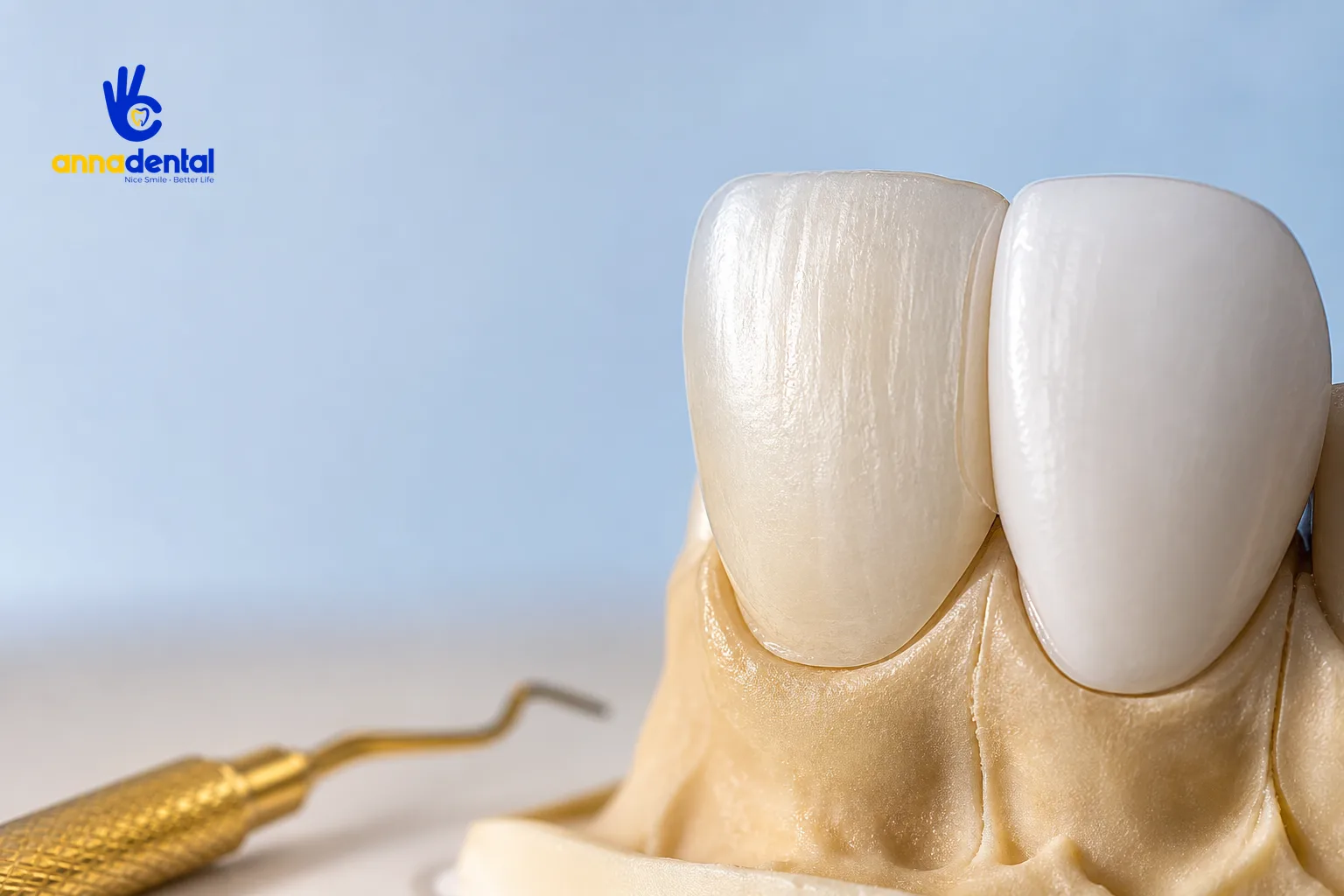 Cận cảnh mặt dán veneer mỏng dán trên răng thật