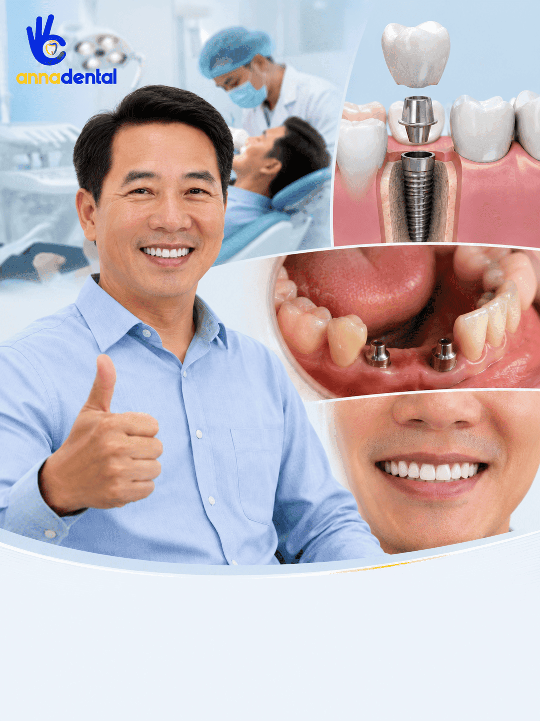 Trồng Răng Implant