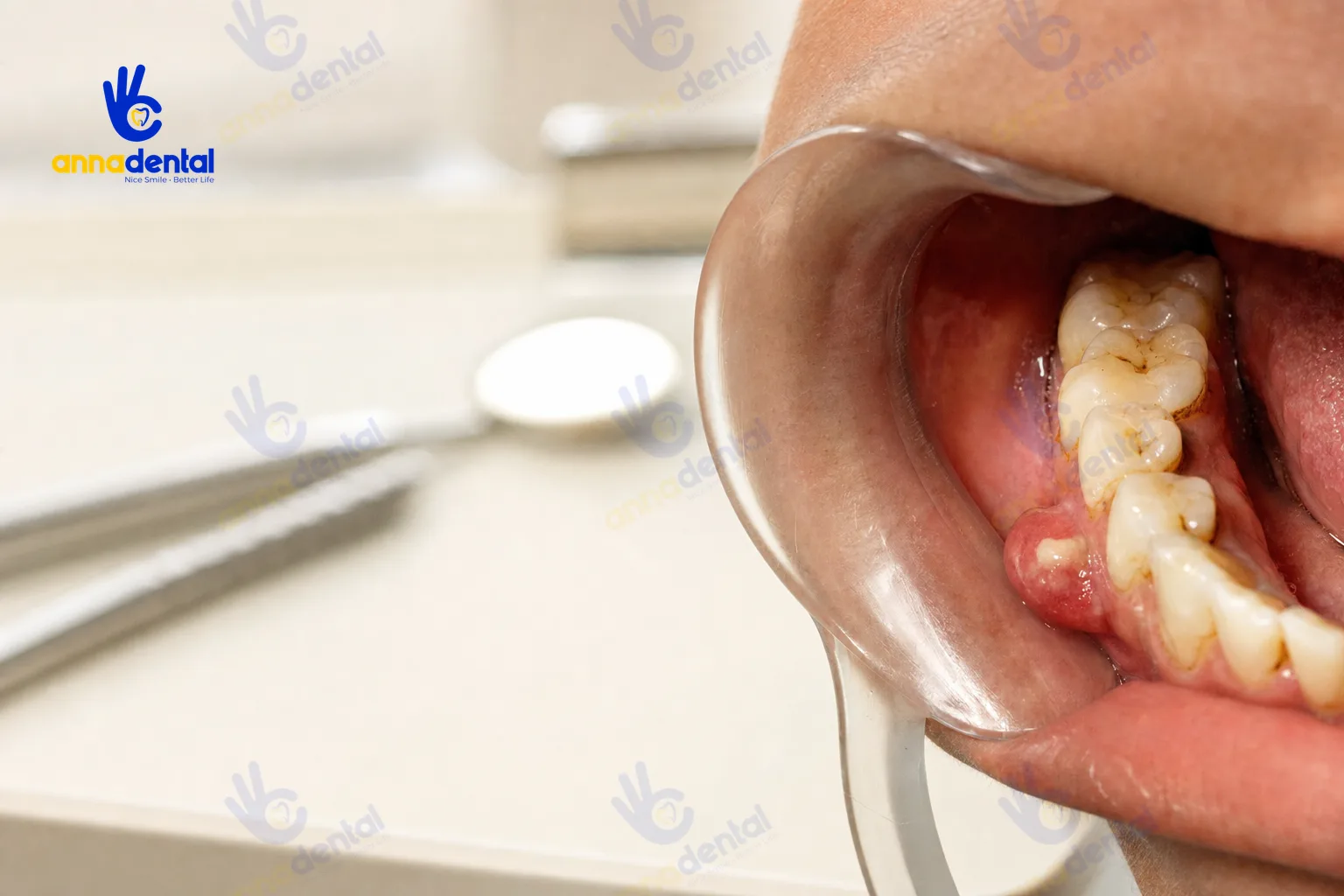 Cận cảnh áp xe răng với vùng nướu sưng đỏ chứa mủ