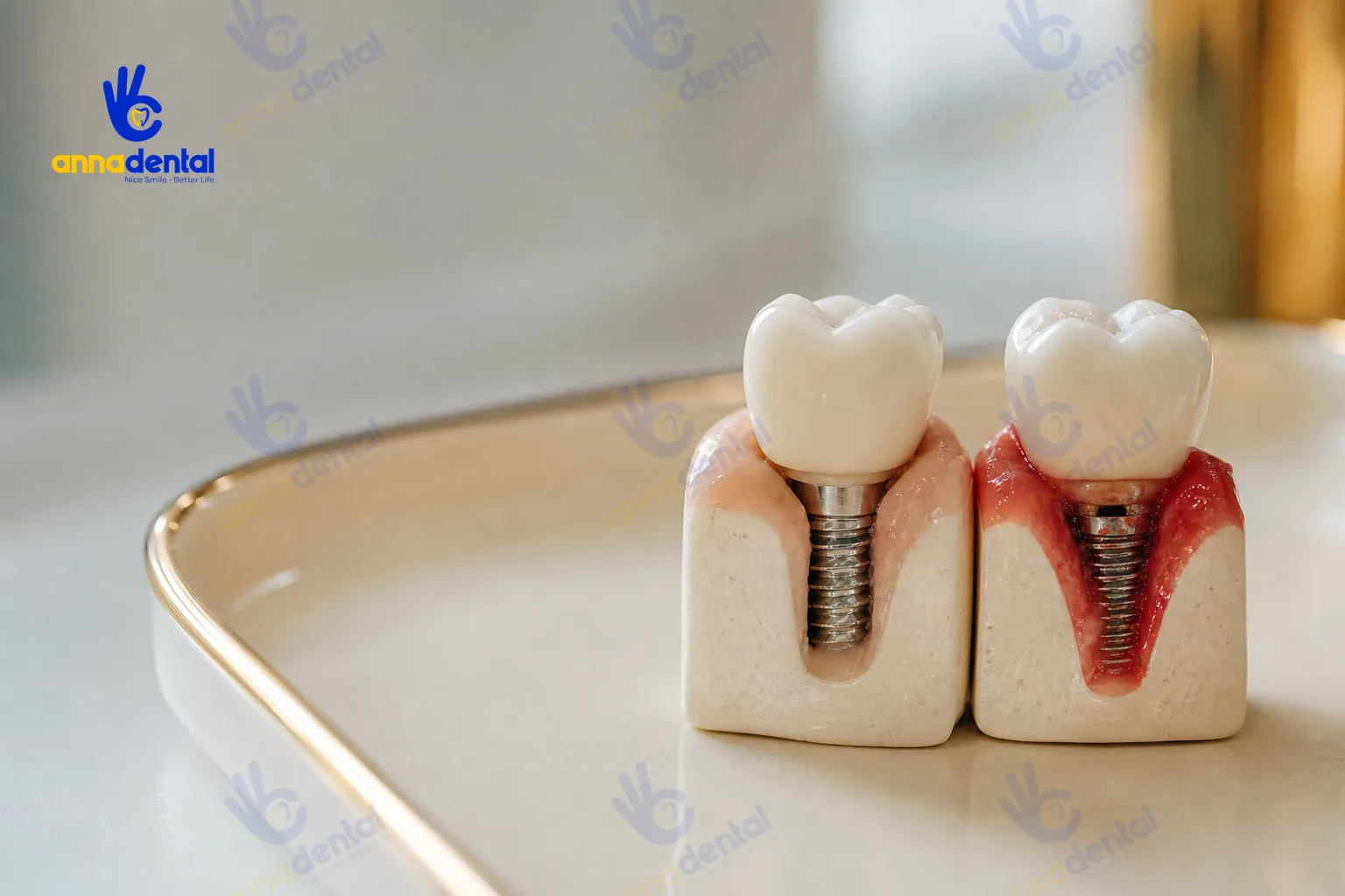 Mô hình hàm răng thật với implant viêm đỏ và trụ lộ nhẹ