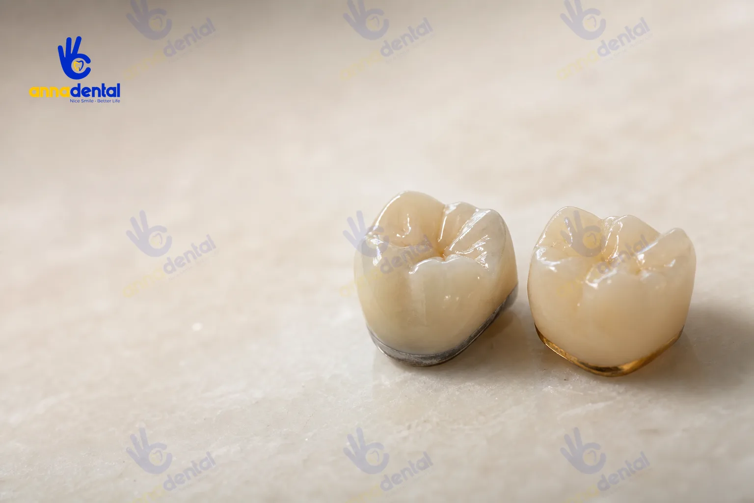 Hai mão răng sứ kim loại và toàn sứ đặt cạnh nhau trên nền trắng ngà