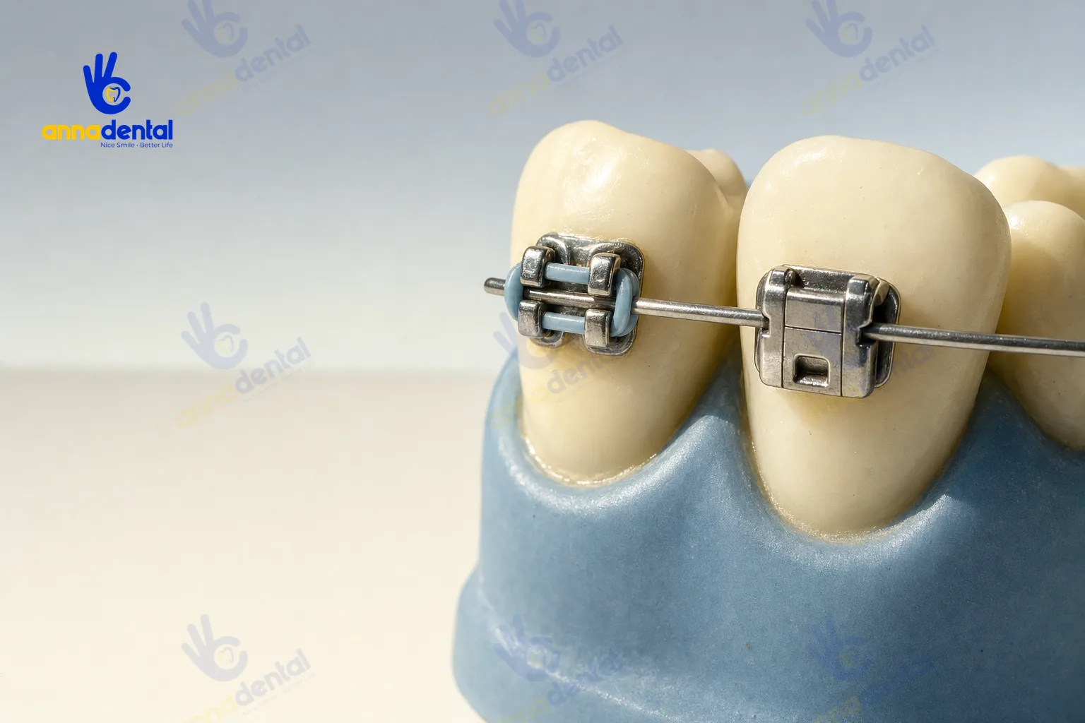 So sánh cận cảnh mắc cài kim loại thường và kim loại tự buộc