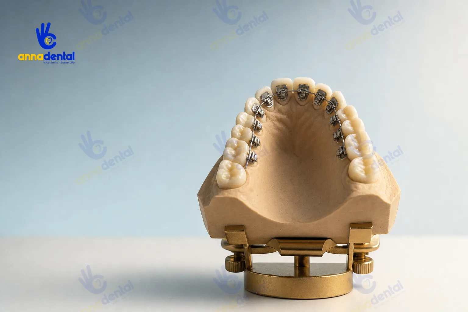 Cận cảnh mắc cài mặt trong gắn phía lưỡi trên mô hình răng