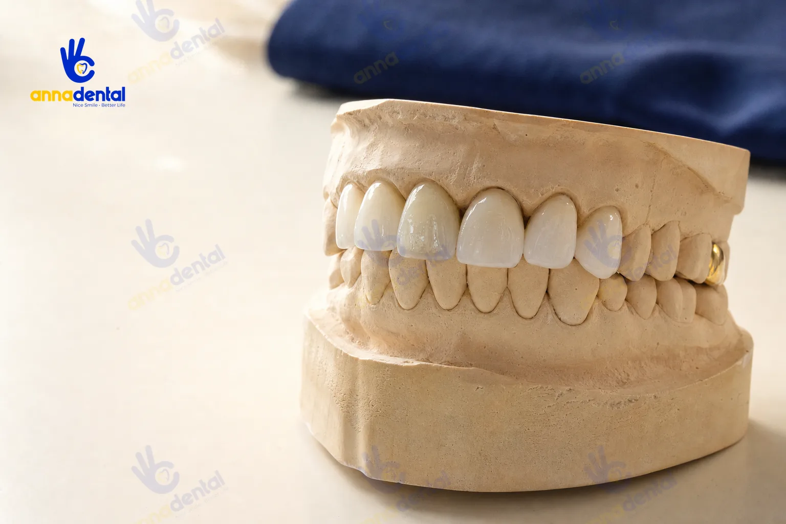Mô hình răng với nhiều mão răng toàn sứ khác nhau để so sánh