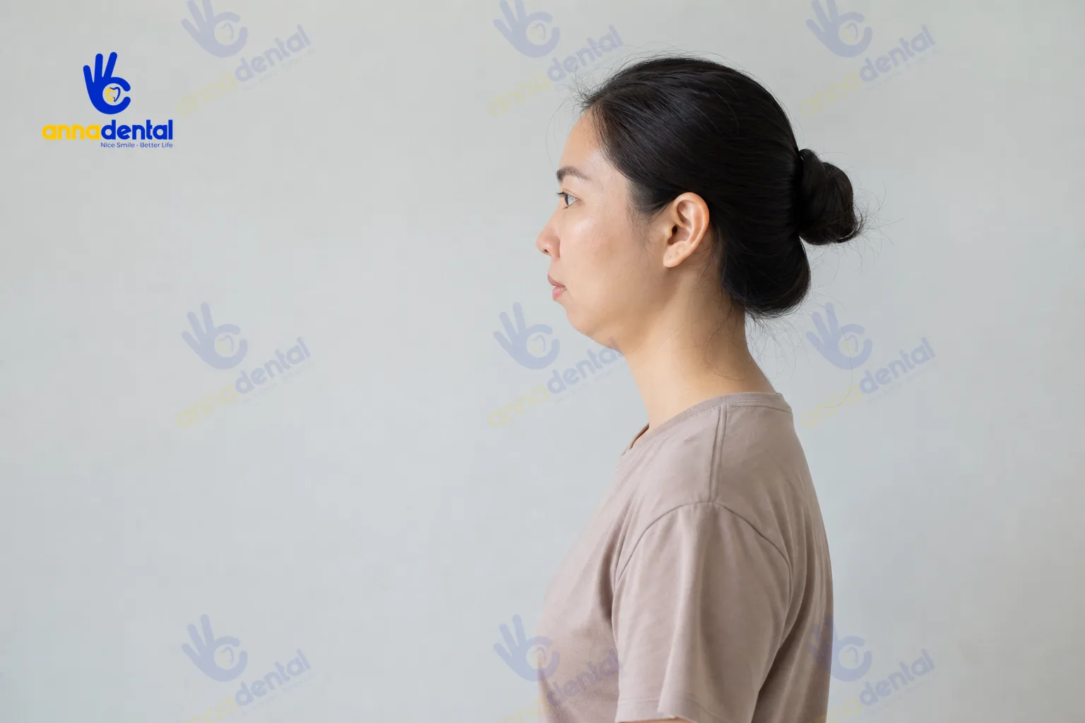 Góc nghiêng minh họa cằm lẹm là gì và cách khắc phục cơ bản