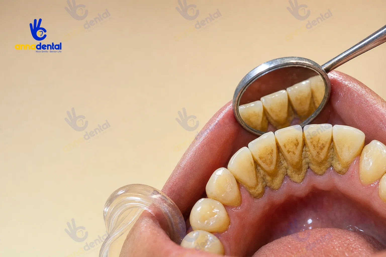 Cận cảnh cao răng bám dày trên mặt trong răng cửa