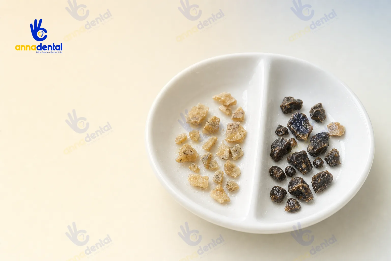 Mảnh cao răng trên nướu và dưới nướu đặt cạnh nhau