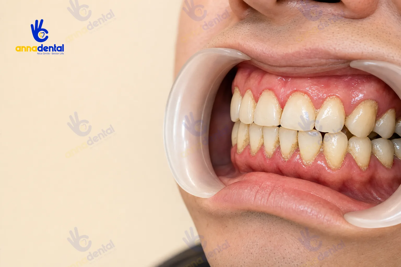 Nướu đỏ sưng nhẹ xung quanh vùng răng có cao răng