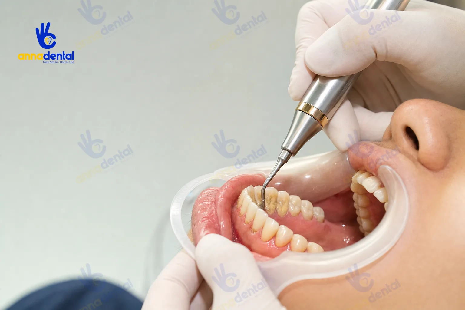 Bác sĩ dùng máy siêu âm lấy cao răng vùng răng cửa