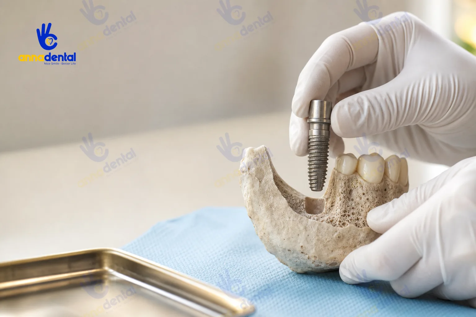 Bàn tay bác sĩ cầm trụ Implant kế bên mô hình xương hàm