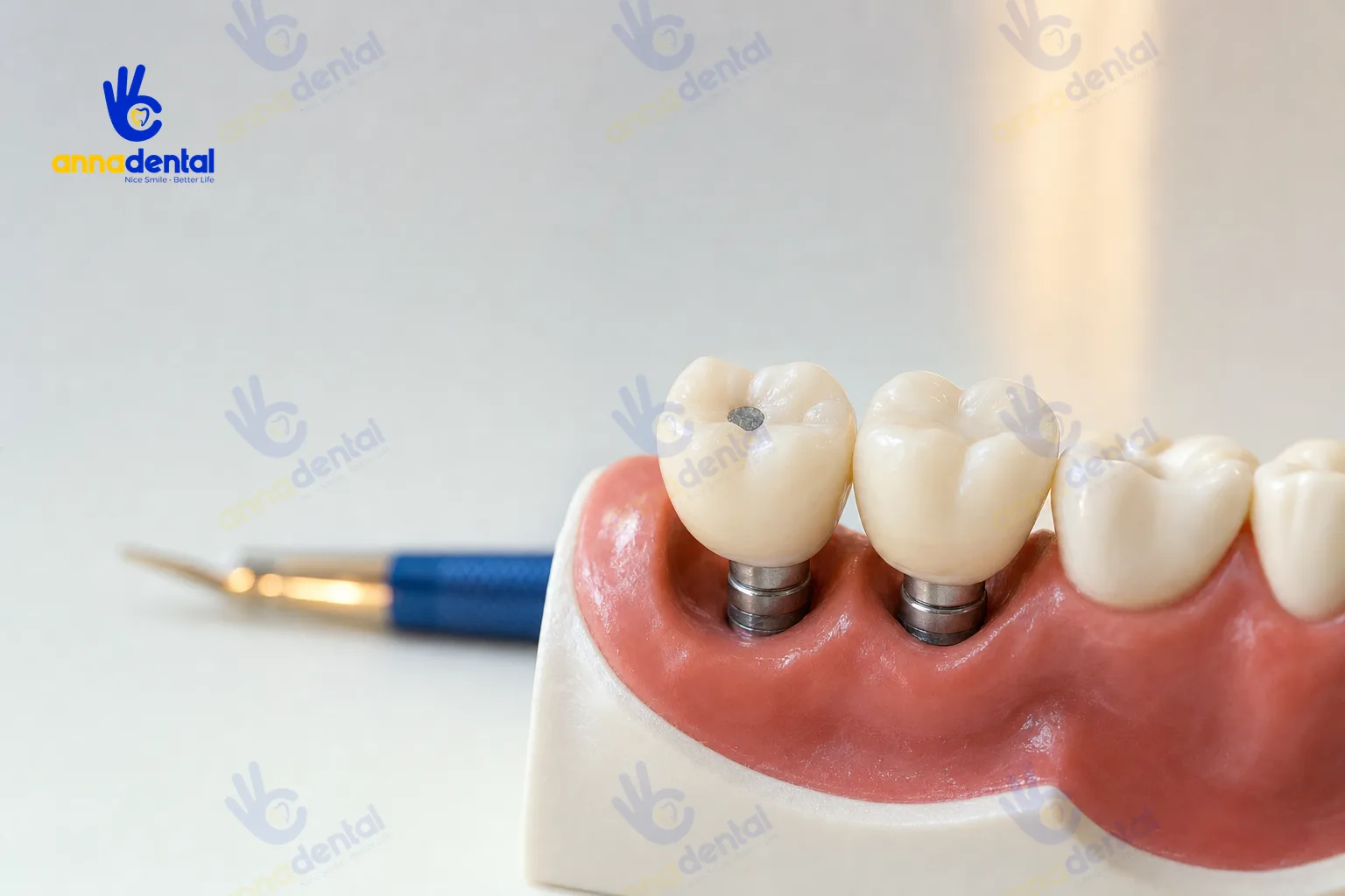 So sánh mão sứ implant bắt vít và mão gắn xi măng
