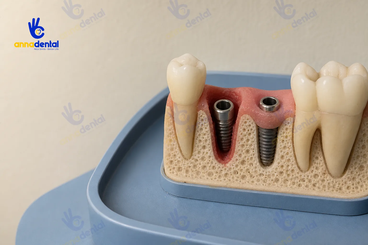 So sánh cấu trúc trụ implant vừa cắm tức thì và trì hoãn trên mẫu hàm