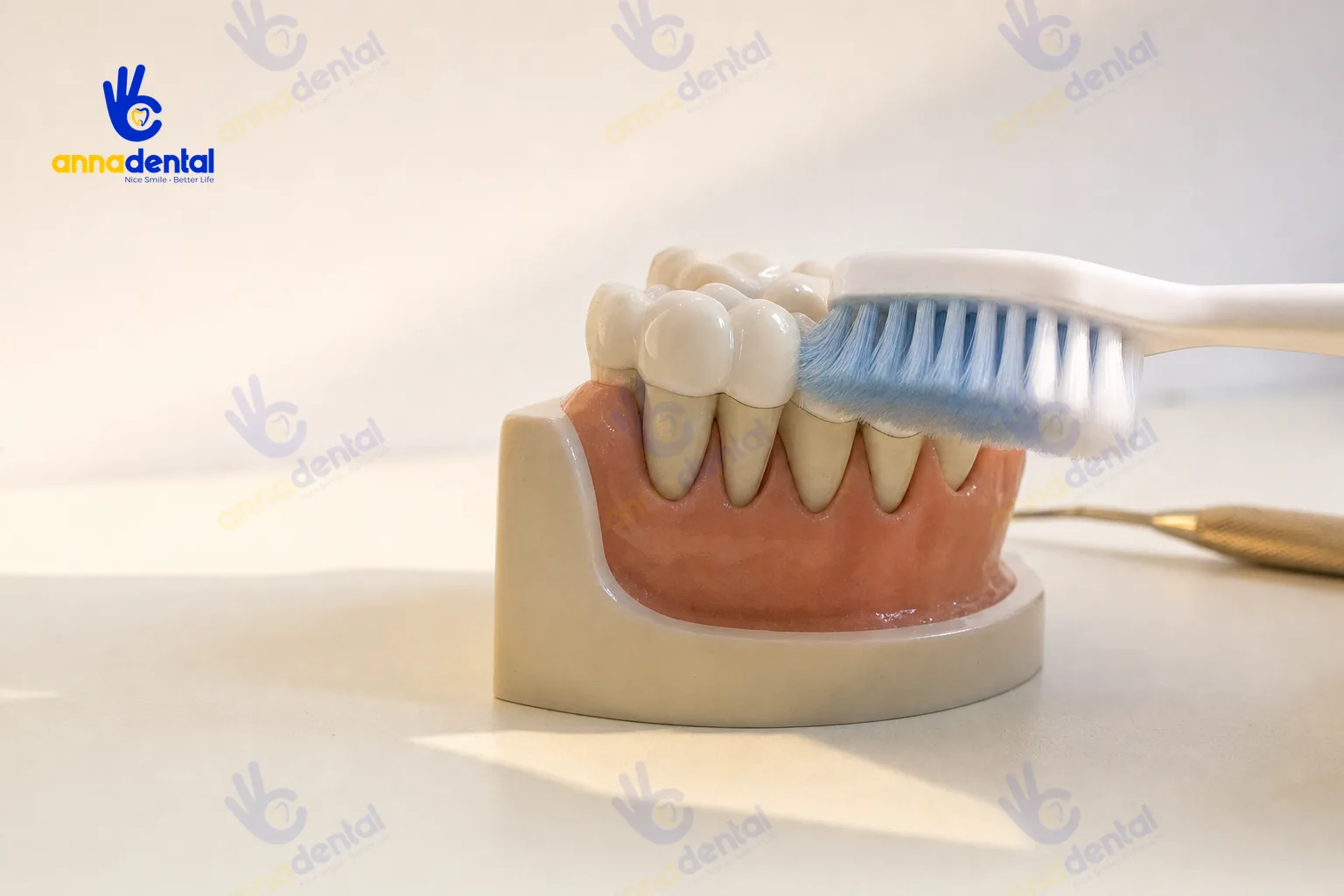 Minh họa chải ngang mạnh tay gây hại viền nướu quanh răng sứ