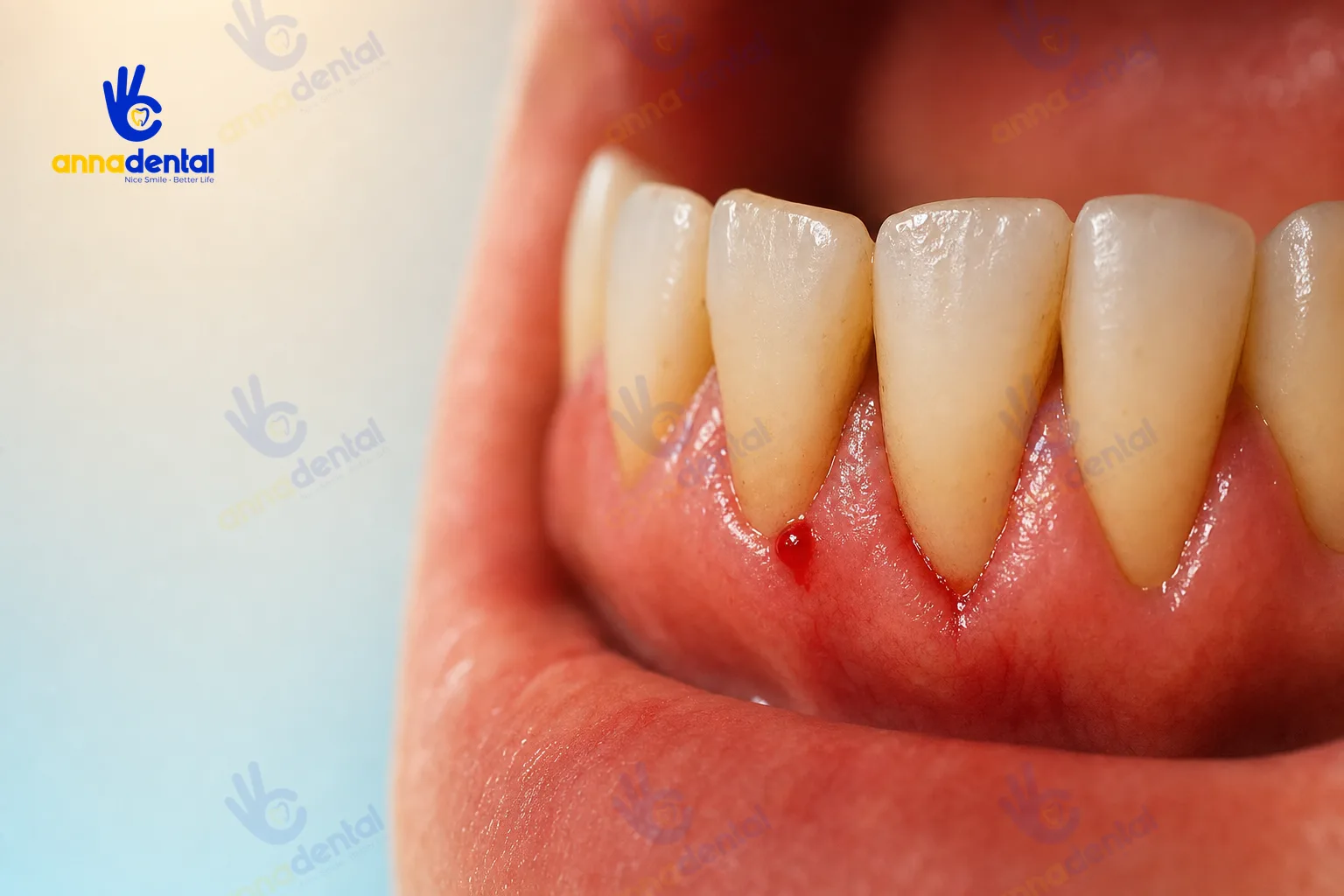 Chảy máu chân răng: cách nhận biết mức độ và xử trí đúng