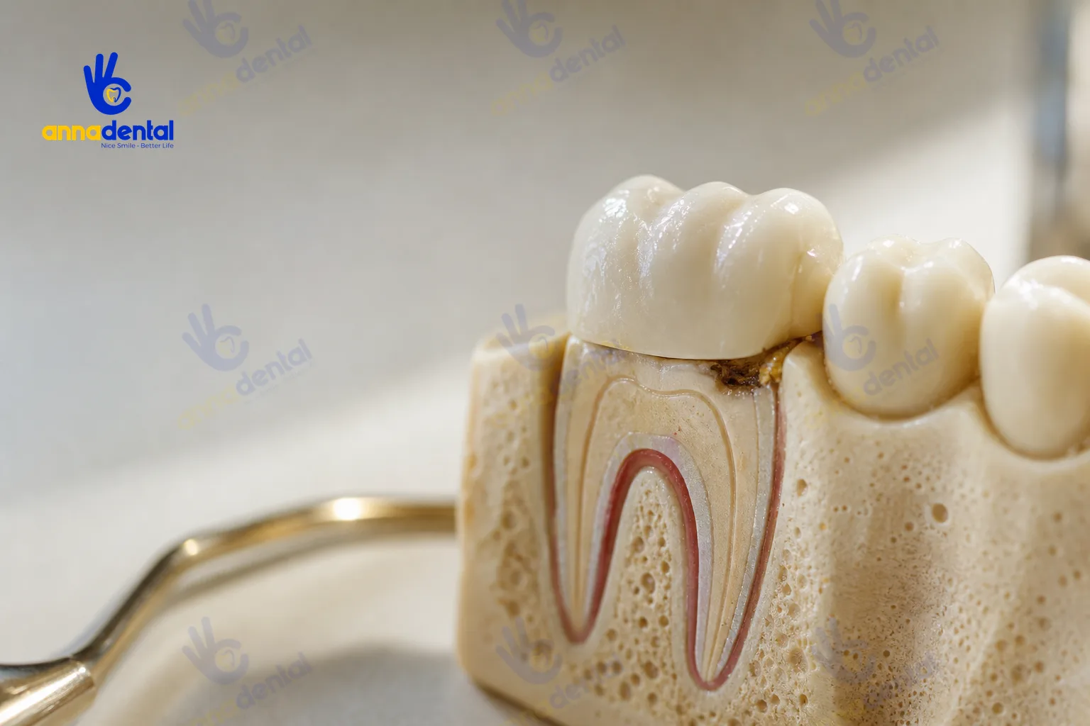 Mô hình răng sứ lắp trên hàm, một răng có khe hở cổ
