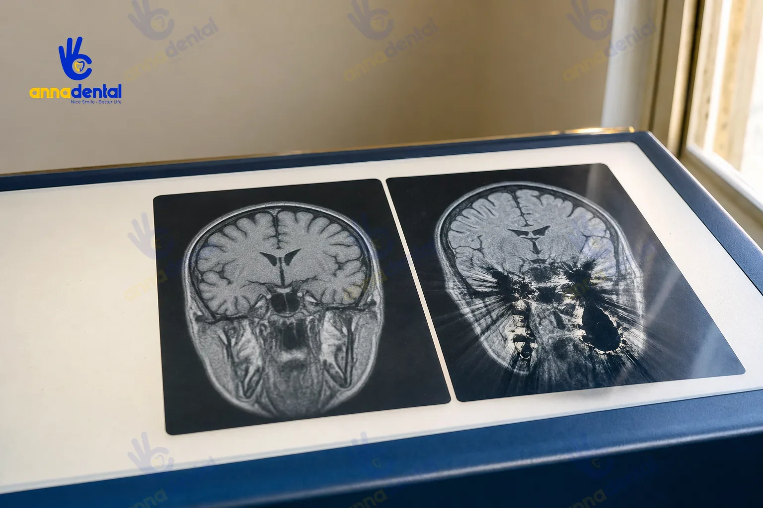 So sánh phim MRI có và không có nhiễu ảnh do kim loại