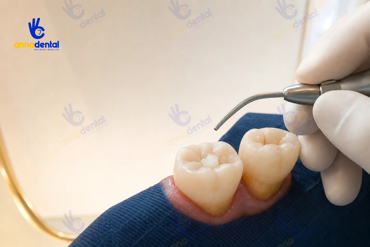 Răng hàm thật có vùng cổ răng lộ dễ gây ê buốt