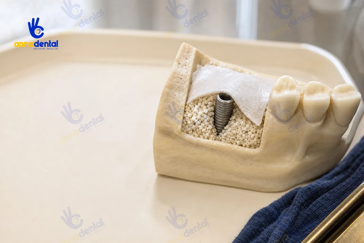 Mô hình minh họa ghép xương trong cấy Implant trên xương hàm
