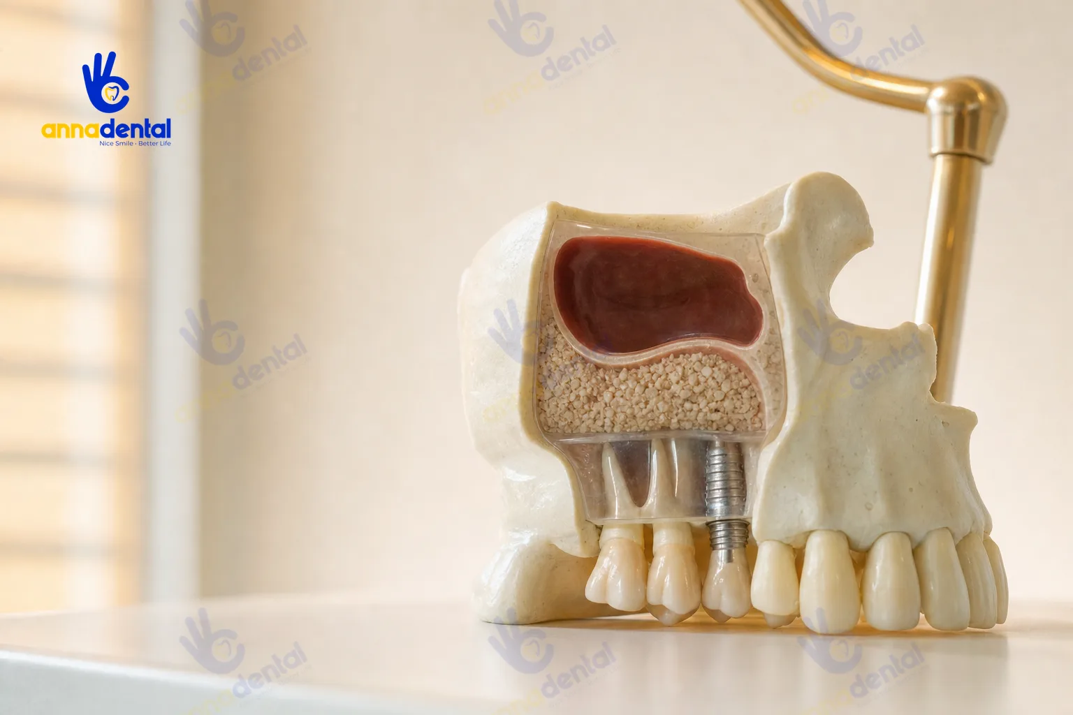 Mô hình xoang hàm trên minh họa kỹ thuật nâng xoang khi cấy Implant