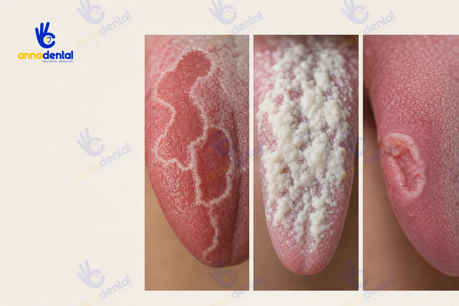 So sánh lưỡi bản đồ, nấm lưỡi và tổn thương nghi ung thư