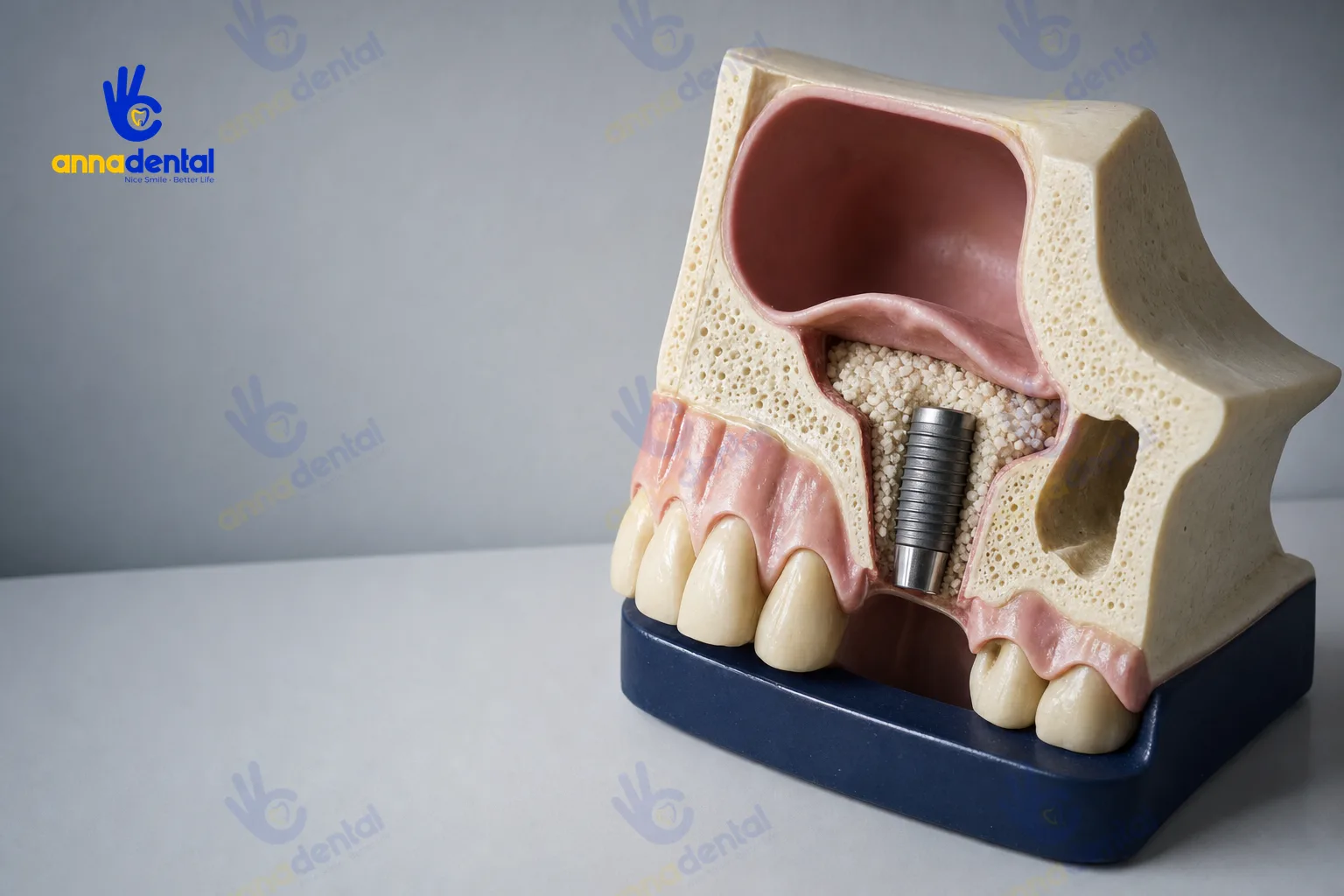 Mô hình minh họa nâng xoang hở trong cấy ghép implant là gì