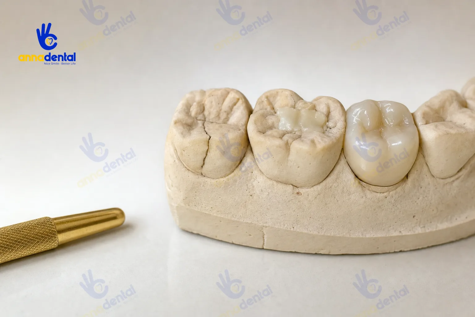 Mẫu hàm thể hiện răng nứt, trám và bọc sứ do nghiến răng