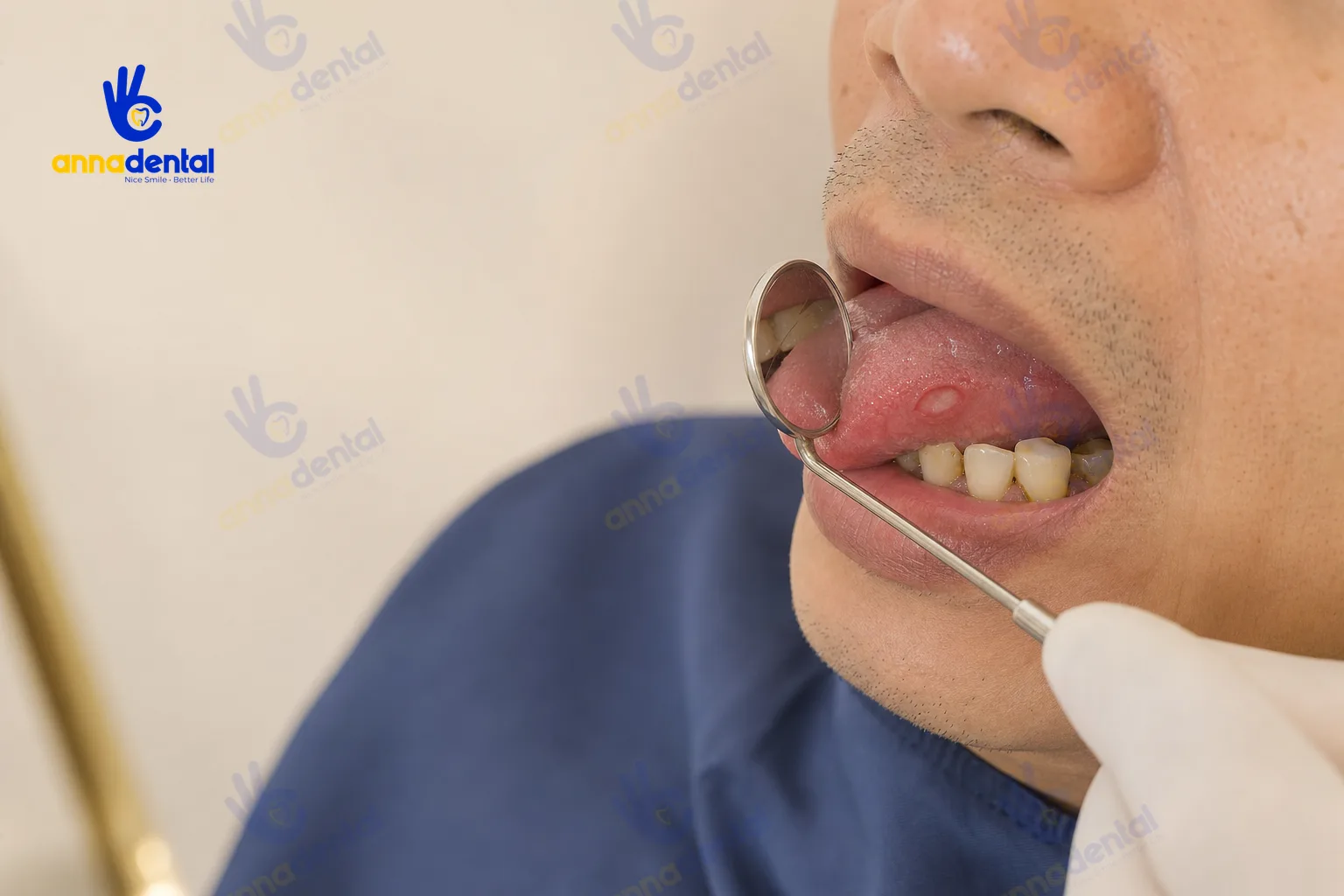 Vết loét nhỏ ở rìa lưỡi gần cạnh răng sắc