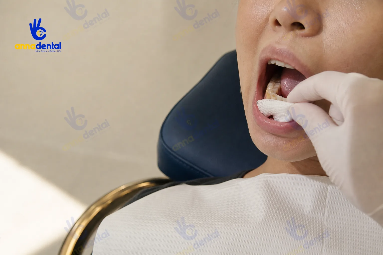 Đặt gạc cầm máu sau nhổ răng cho bệnh nhân