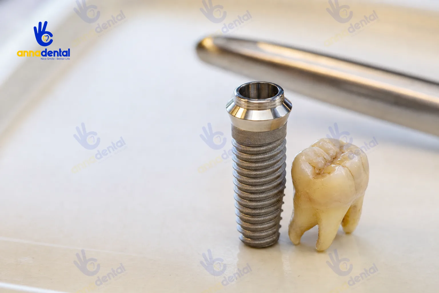Cận cảnh trụ Implant cạnh răng mới nhổ minh họa nhổ răng bao lâu thì cấy Implant được
