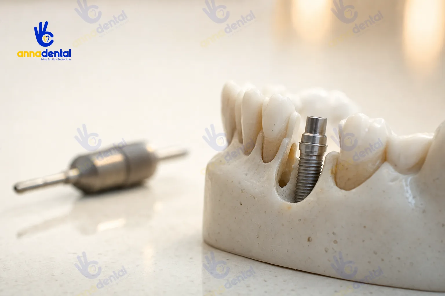 Mô hình hàm với trụ Implant cấy tức thì vào ổ răng mới nhổ