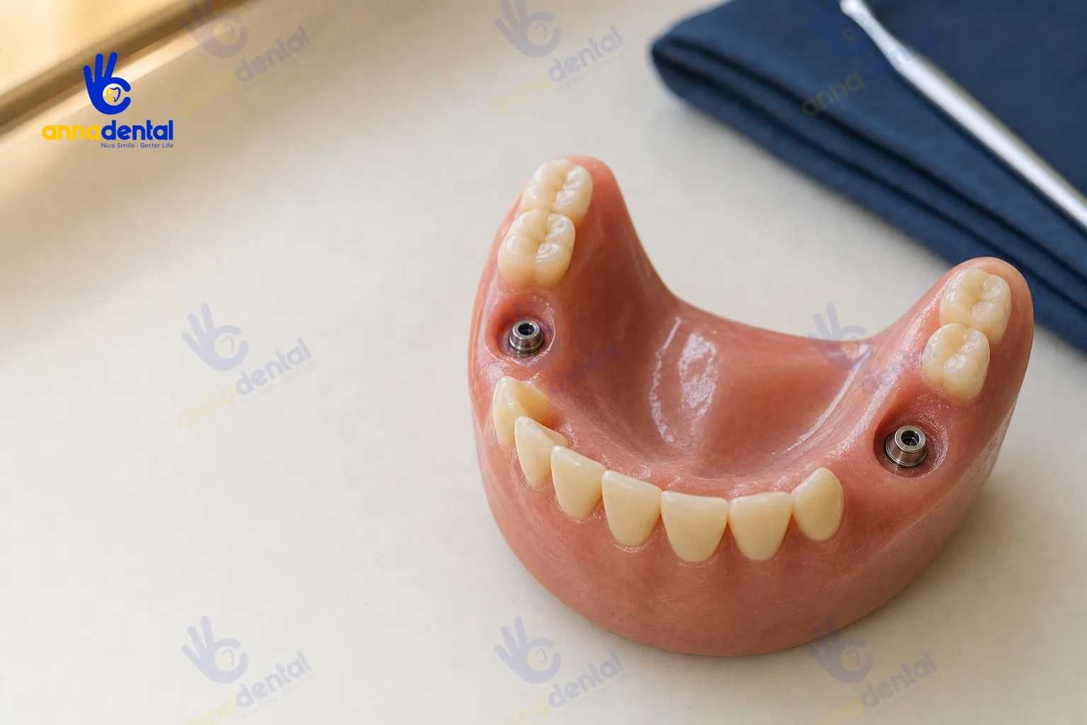 Mô hình hàm thể hiện cấy Implant sớm và cấy muộn ở các vị trí khác nhau