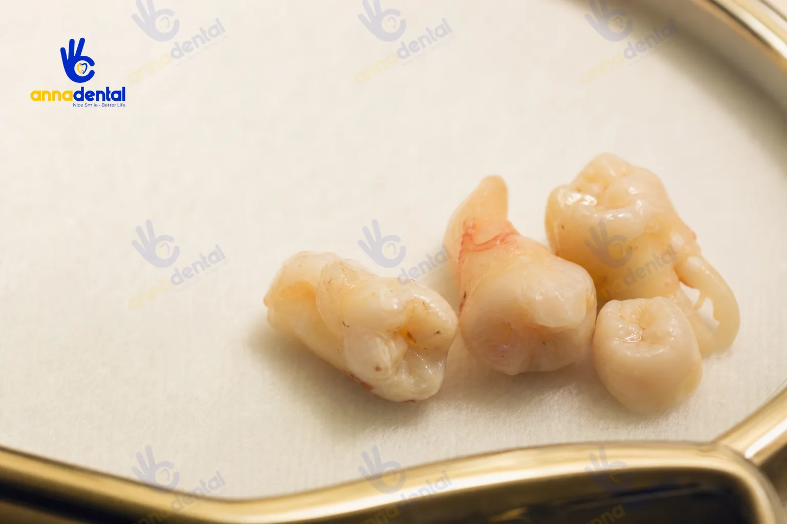 Răng thật vừa nhổ trên khay sạch tại phòng khám, minh họa chủ đề nhổ răng khôn