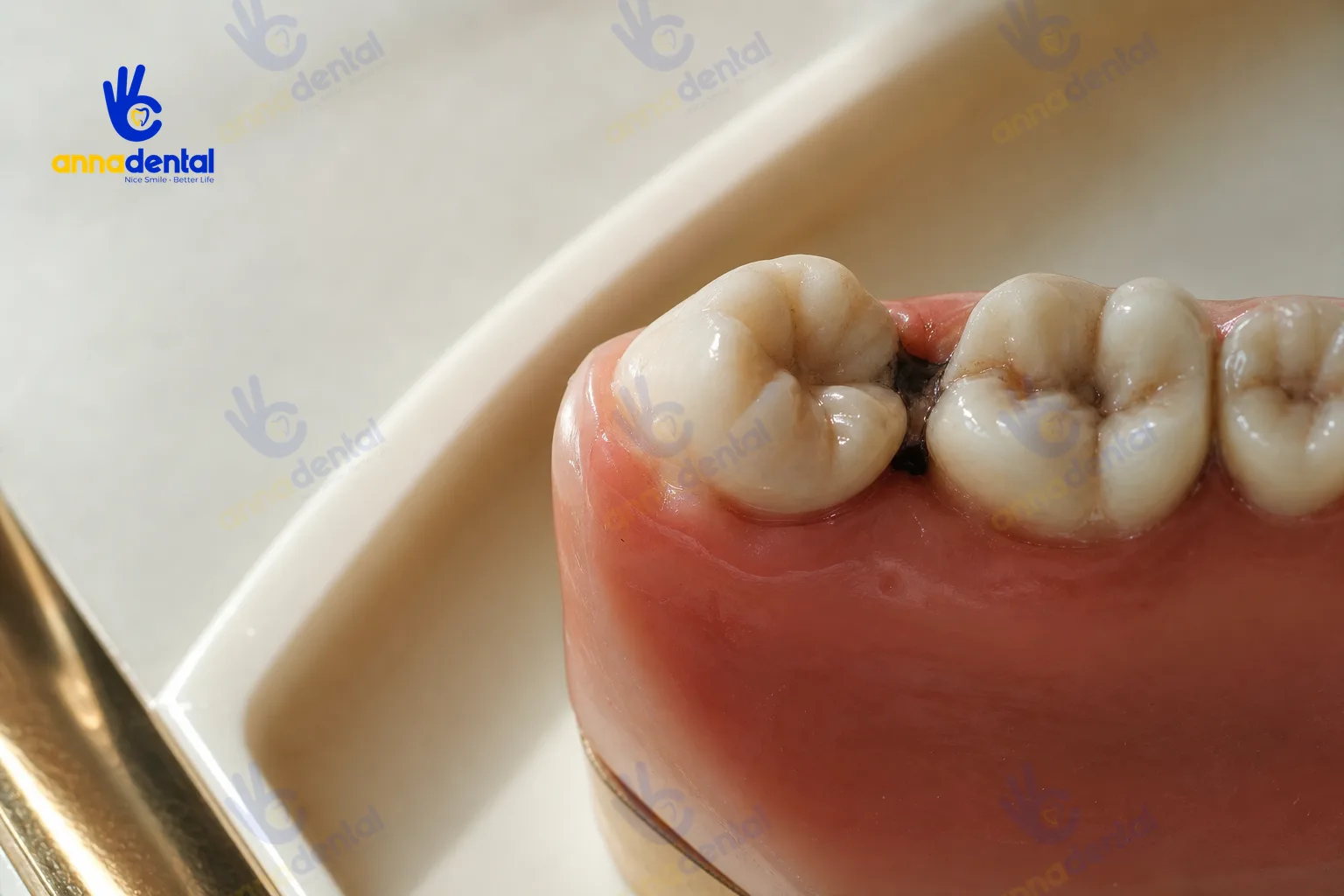 Mô hình cho thấy biến chứng sâu răng lan từ răng khôn sang răng số 7
