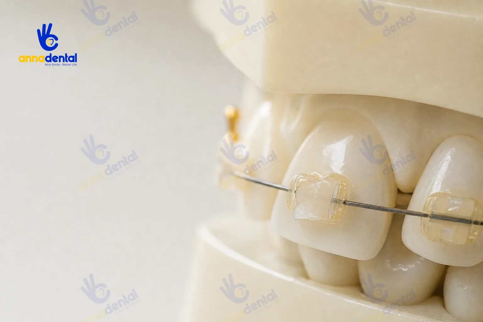 Mắc cài sứ bị sứt vỡ cạnh, dây chun hơi ố vàng do dùng lâu