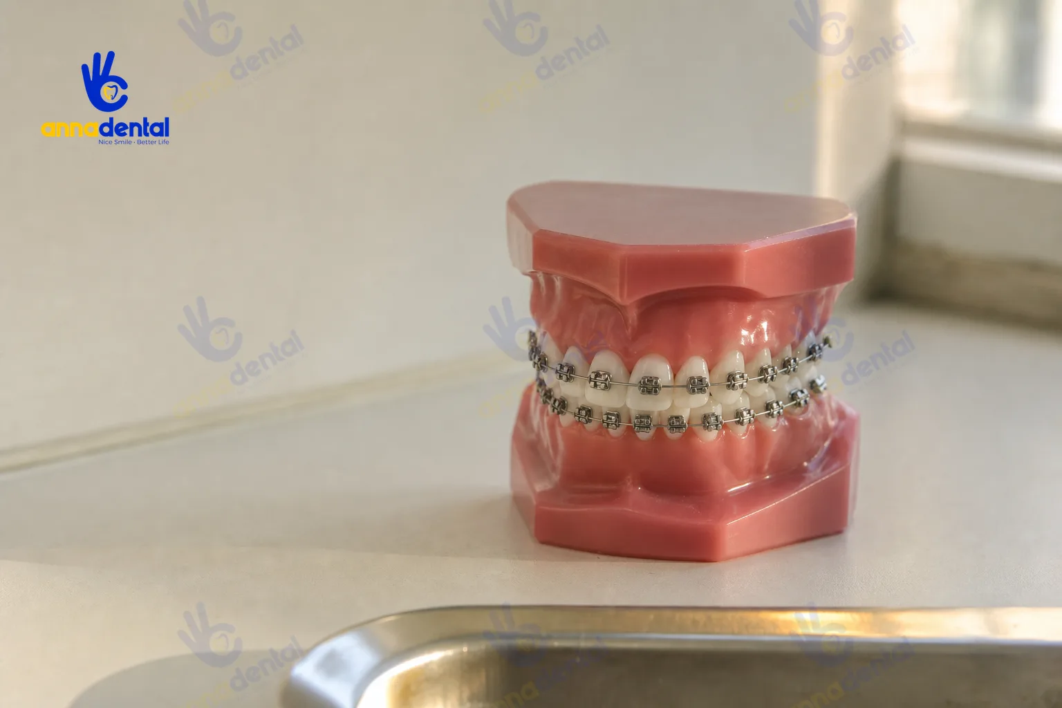 Ảnh cận cảnh minh họa niềng răng mất bao lâu với khí cụ mắc cài